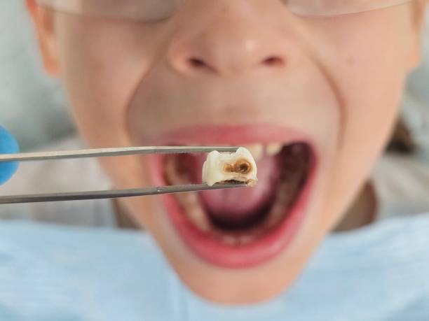 Best Broken Tooth Emergency  in Athens, AL