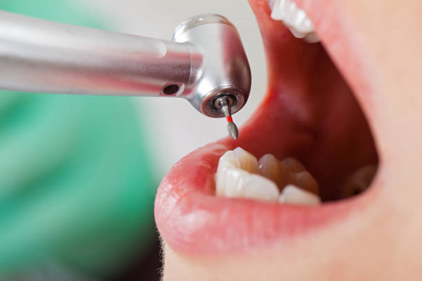 Emergency Dental Filling Replacement in AL